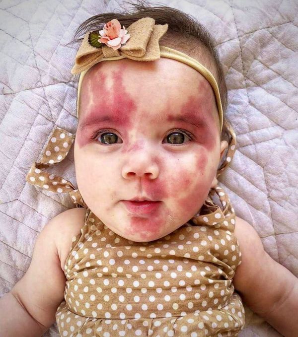 Baby Called “Hideous” and “Defective” for Red Birthmark, But Wait Until You See This Adorable Child Now