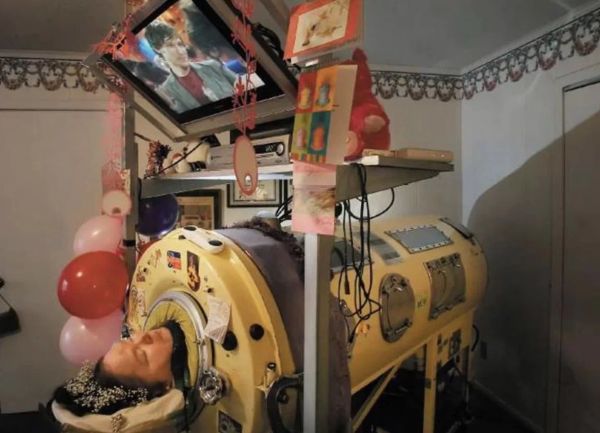 Woman Who Spent Life in Iron Lung Inspires with Her Unbreakable Spirit