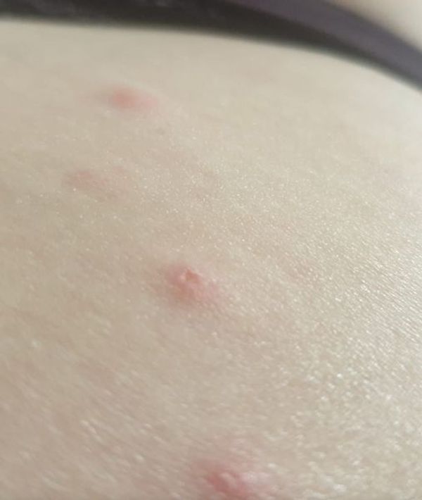 Identifying Common Bug Bites: A Guide for Effective Treatment