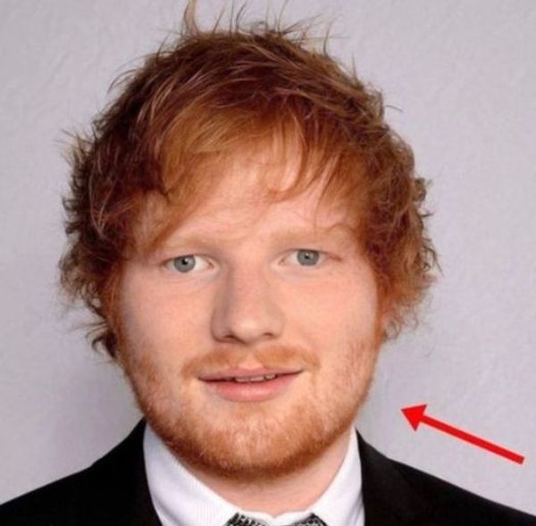 Urgent Call for Prayers: Ed Sheeran Battles Inoperable Tumor