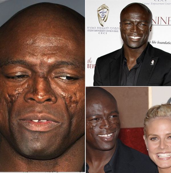 Seal’s Trademark Face Scars: A Unique Journey