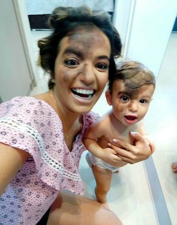 A Mother’s Love: Supporting Her Son’s Unique Birthmark