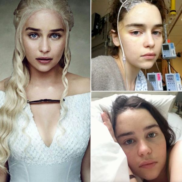 Emilia Clarke Survives Two Brain Aneurysms – A Battle of Resilience and Strength